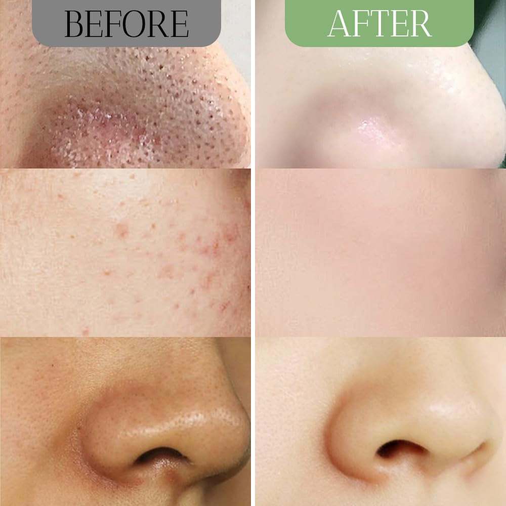 Before and after images showing clear skin and reduced blackheads using Green Tea Clay blackhead remover mask