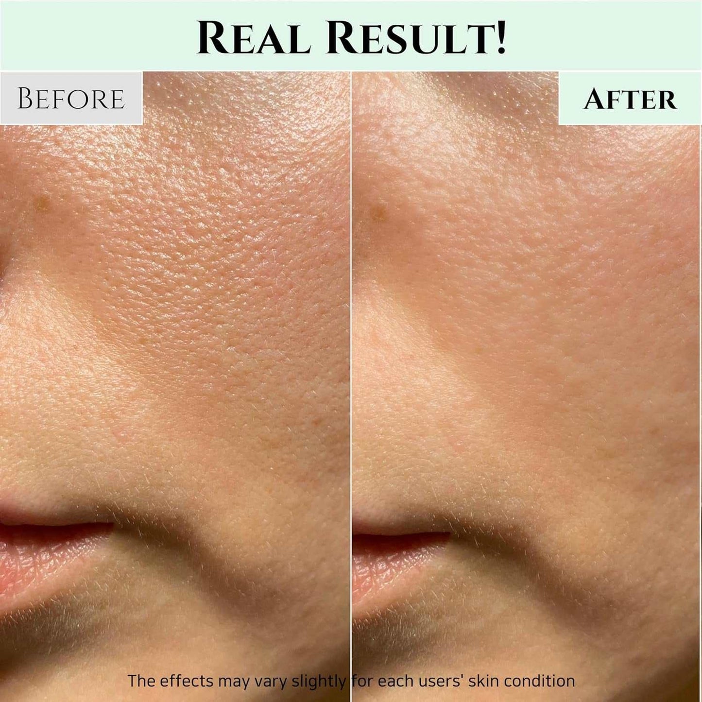 Before and after image showing results of using a deep pore blackhead remover, highlighting smoother, clearer skin.